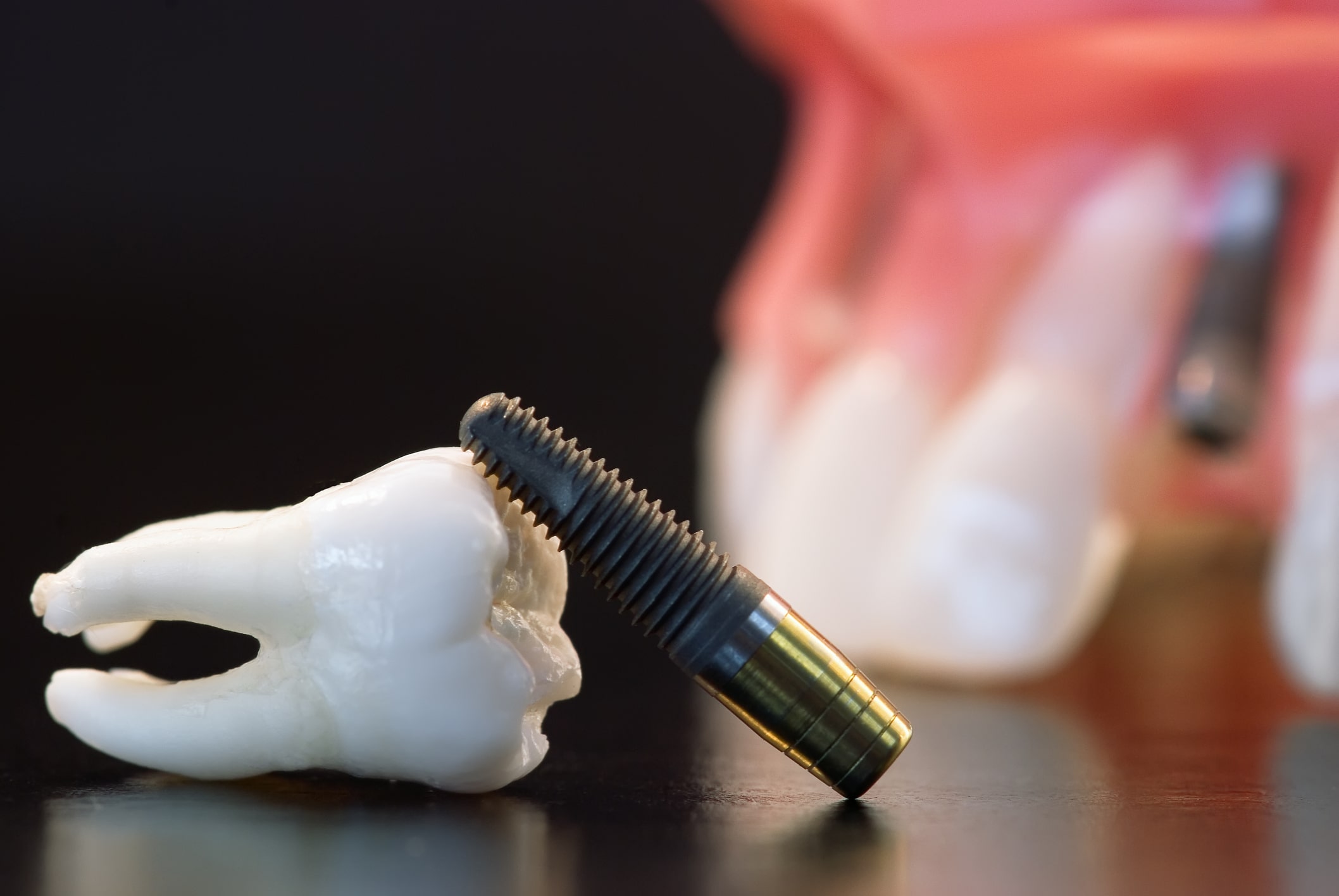 Control de rutină după inserarea unui implant dentar în București